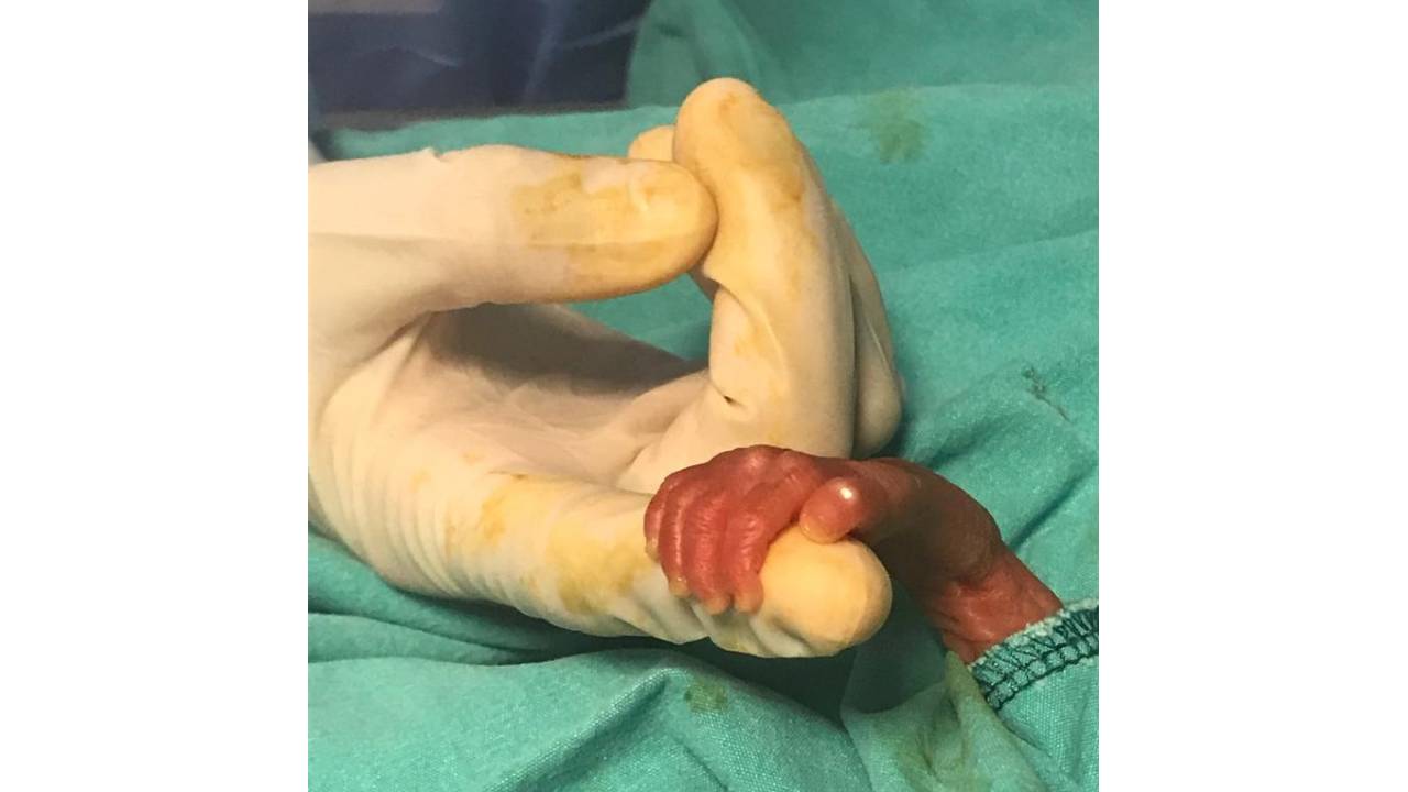 540 Gramlık Parmak Bebek Rabia'yı Kök Hücre Tedavisi Hayata Bağladı