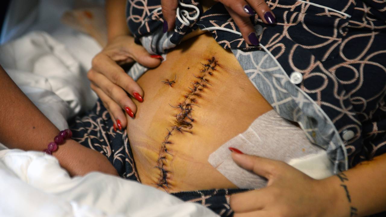 Eski Sevgili Dehşeti; Midesinin Yüzde 30'u Alındı, Vücuduna 135 Dikiş Atıldı