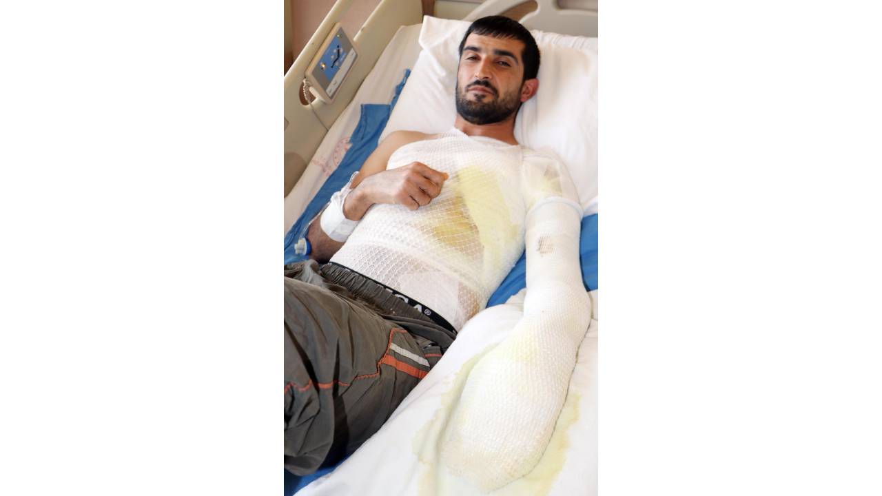 Epilepsi Nöbeti Geçirirken, Kaynayan Çorba Kazanına Düştü